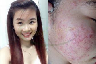 Cách trị mụn cám, mụn đầu đen, mụn ẩn trong da, thâm, da nhờn - MSKH: TN11266